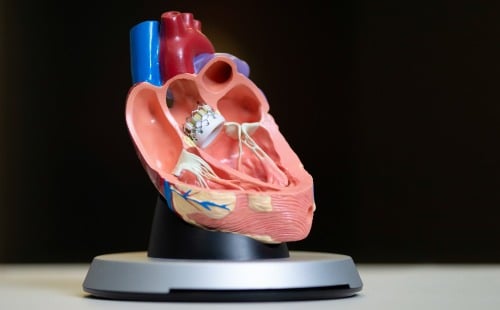 Transcatheter Aortic Valve Replacement