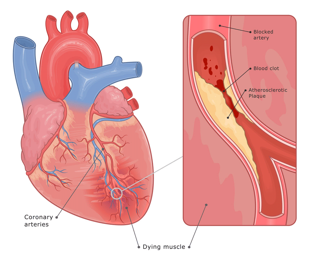 myocardial infarction